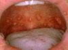 Sores on the inside of the mouth causes by hand-foot and mouth disease